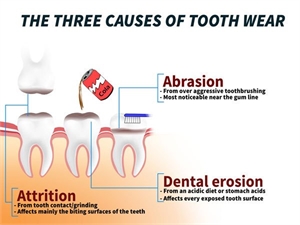 Dental erosion, abrasion and attrition may cause severe tooth wear.
