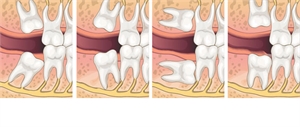 Positioning of Wisdom Teeth