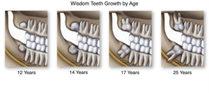 Wisdom teeth growth by age