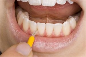 Cleaning lower incisors with an interdental brush