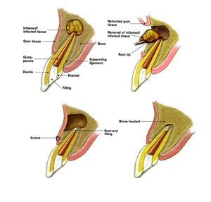 Apicoectomy procedure explained