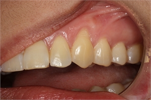 Gum recession on the upper left canine due to overbrushing. Right-handed patients tend to press their toothbrushes harder when brushing the teeth on the left. This is the reason sometimes you can see gum recession only on the left teeth.