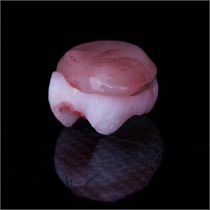 This is an undeveloped wisdom tooth extracted by the dentist - the procedure is called germectomy