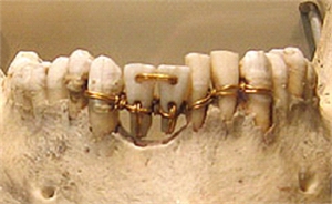 In 2500 B.C. the Egyptians used gold wire ligatures to help stabilize damaged or loose teeth.