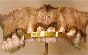 Phoenicians used gold wires to splint teeth compromised by periodontal infection and decay.