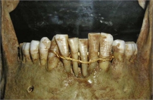 Gold Wires Teeth Splinting