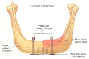 Transosteal Dental Implant