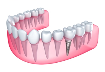  Types and benefits of Dental implants