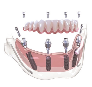 All on Four Implants - A Permanent Solution for Temporary Teeth Loss