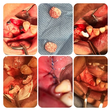 Dental Implant surgery