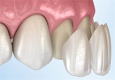 The Benefits of Porcelain Veneers - A Comprehensive Review