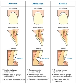 Causes, anatomy and treatment of dental abrasion, abfraction and erosion