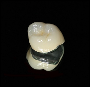 Porcelain fused to metal dental crown is also known as VMK crown or a veneered metal crown.