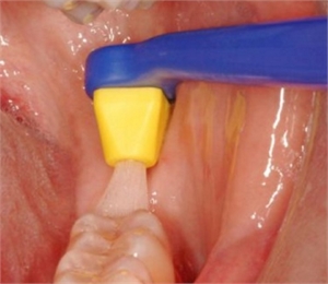 Sulcular Toothbrushing