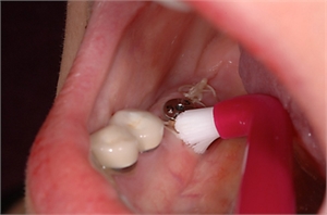 Sulcular toothbrushing around a dental implant