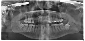 Panorex is a diagnostic full mouth x-ray