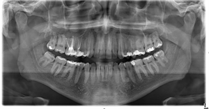 The panoramic x-ray is a dental radiograph showing the upper and lower jaw. It is also known as OPG, panoral, panorex, orthopantomogram or a full mouth radiograph.