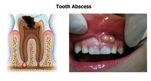 This is how a tooth abscess look like - animation and clinical photo.