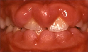 Hyperplasia of the gingiva
