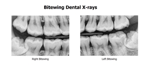 Bitewing dental x-rays
