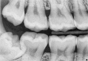 Bitewing radiographs are dental x-rays taken to detect initial phase of tooth decay in the proximal tooth surfaces.