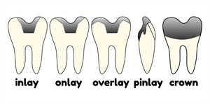 This is the difference between dental crown, dental cap, inlay, overlay, onlay and pinlay. They are all used to restore a damaged tooth but all have specifics and indications in dentistry.
