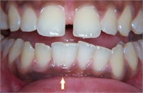 Tooth gemination in dentistry | News | Dentagama