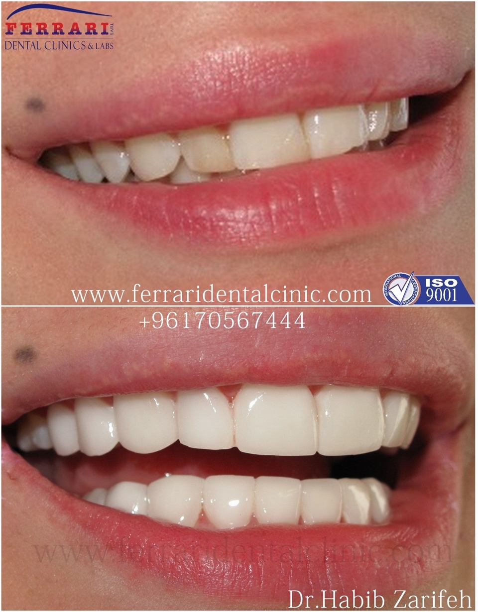 Lumineers Hollywood smile Lebanon by Dr Habib Zarifeh head of CMC Dental Division 