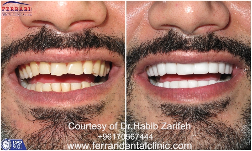 Lumineers Hollywood smile Lebanon by Dr.Habib Zarifeh head of CMC Dental Division