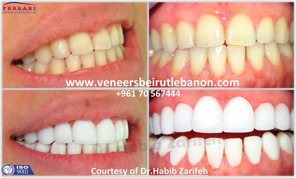Hollywood Smile in Beirut Lebanon with Dr Habib Zarifeh 
