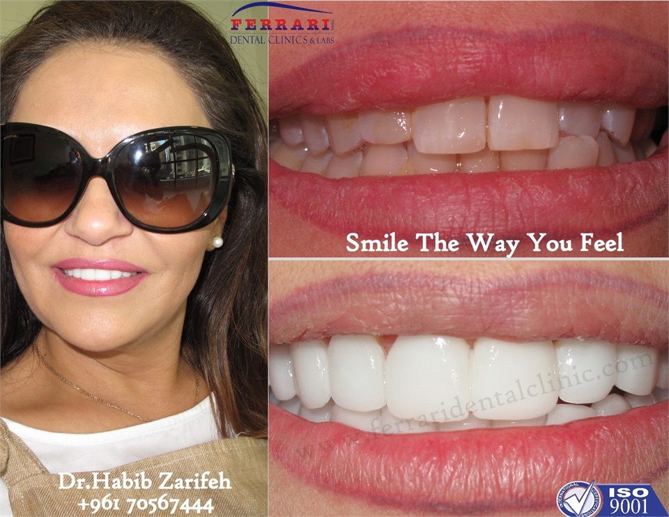 Hollywood smile in Lebanon by Dr.Habib Zarifeh