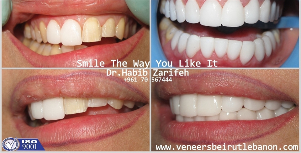 Get back your Smile with the number one Hollywood Smile dentist in Beirut Lebanon Dr Habib Zarifeh