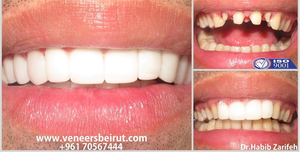 Get back your Smile with the number one Hollywood Smile dentist in Beirut Lebanon Dr.Habib Zarifeh