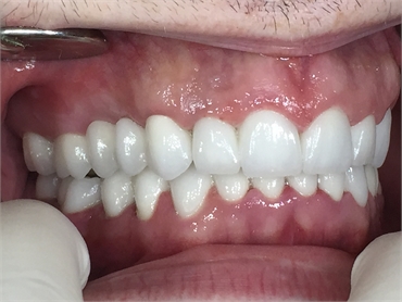 Zirconium dental bridge - AFTER