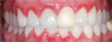 GUM DISEASE CAUSES SIGNS SYMPTOMS AND TREATMENTS
