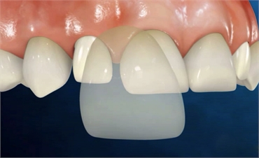Multiply Your Confidence With Porcelain Veneers