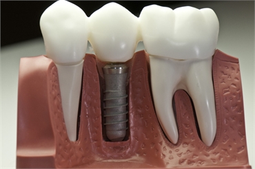 Dental Implants in Ambleside Near Windermere