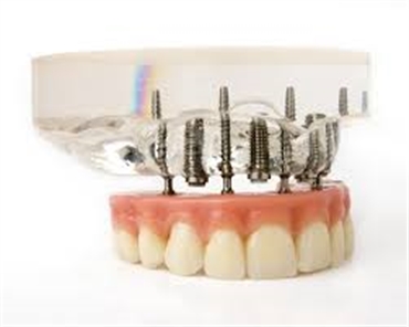 What does getting dental implants involve