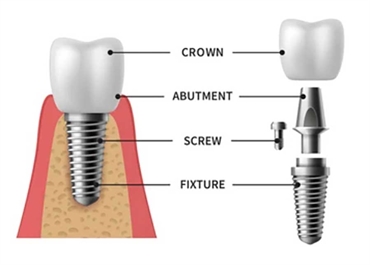 Understanding Dental Implants A Comprehensive Guide