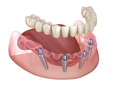 What are the risks or complications with full mouth dental implants