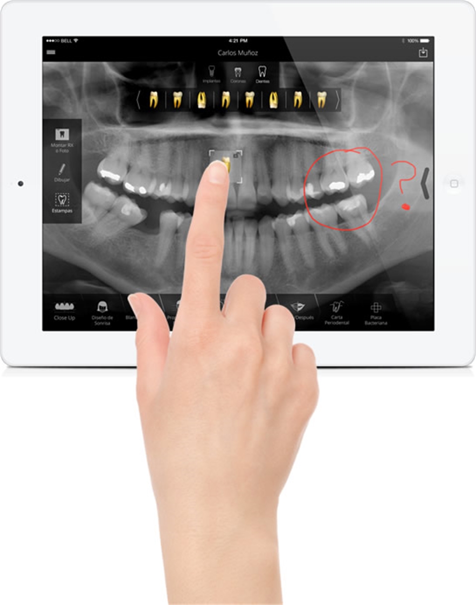 Use SmileHD's drawing to tool to explain X-Rays. 