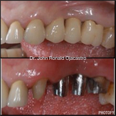 bridge after dental implants