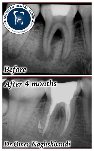 Root canal treatment by Dr.Omer naghshbandi