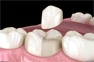 porcelain onlays vs. veneers choosing the right restoration for your smile