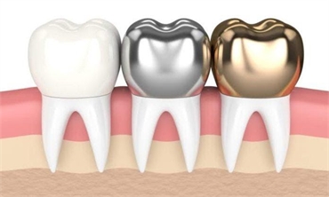 The Different Types of Dental Crowns You Should Know About