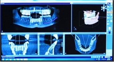 3D Guided Surgery