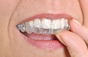 Invisalign Clear Braces in Lake Forest IL