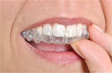 5 Reasons Many Prefer Clear Aligners Over Traditional Braces