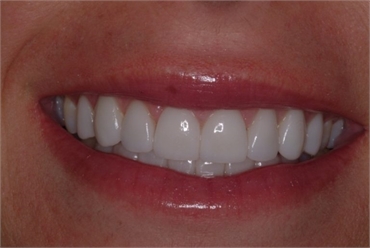 DENTAL BONDING AND COMPOSITE VENEERS IS THE BEST OPTION FOR YOUR DENTAL HEALTH