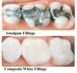 Mercury Is This Heavy Metal and A Poison. Should We Still Be Using Mercury Fillings